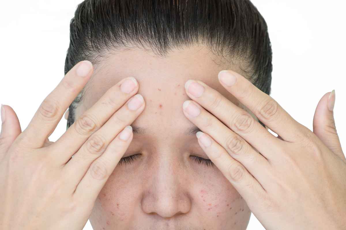 peau à imperfections soins visage peau corps acné