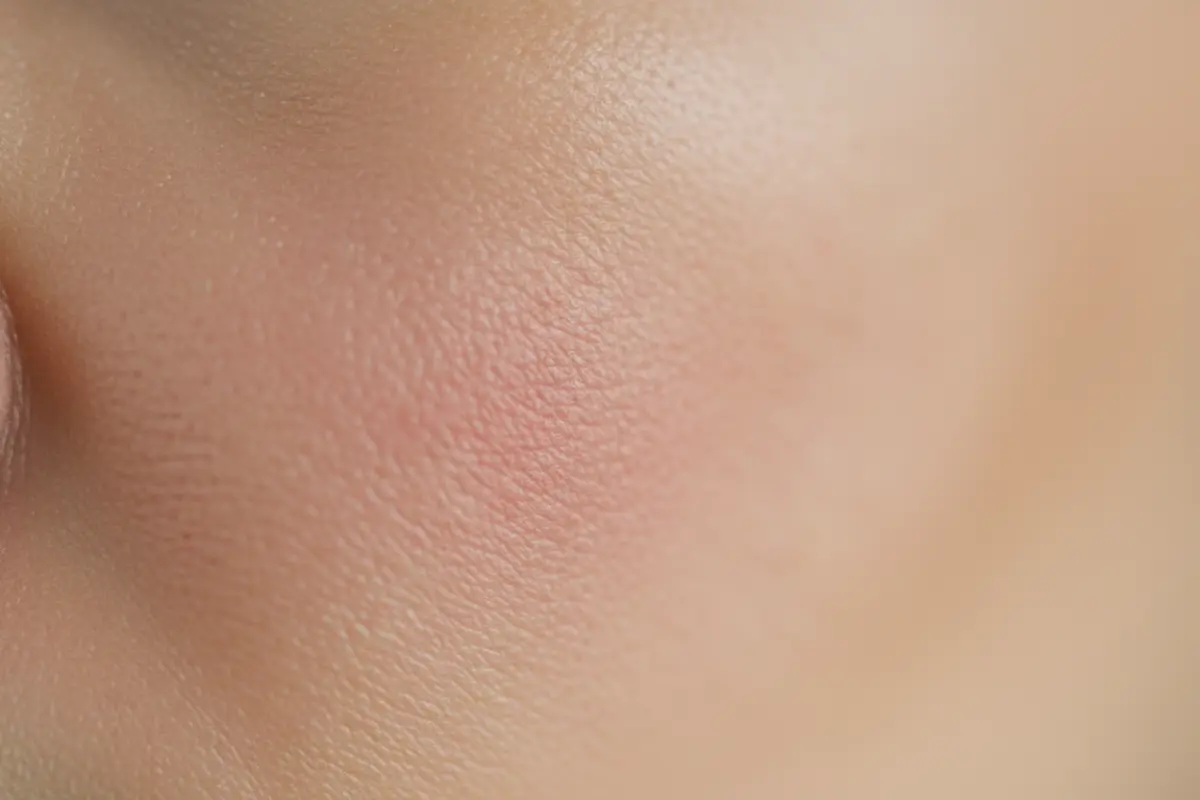 Prendre soin de sa peau sensible au quotidien 3 Rougeur discrète sur peau sensible de femme