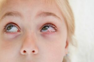 conjonctive maladies yeux conjonctivite